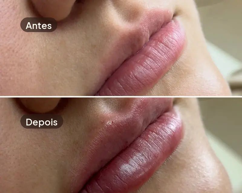 Antes e depois de preenchimento labial de uma paciente da clínica