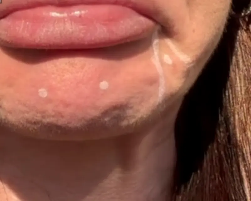 Queixo marcado com os pontos de aplicação da toxina botulínica